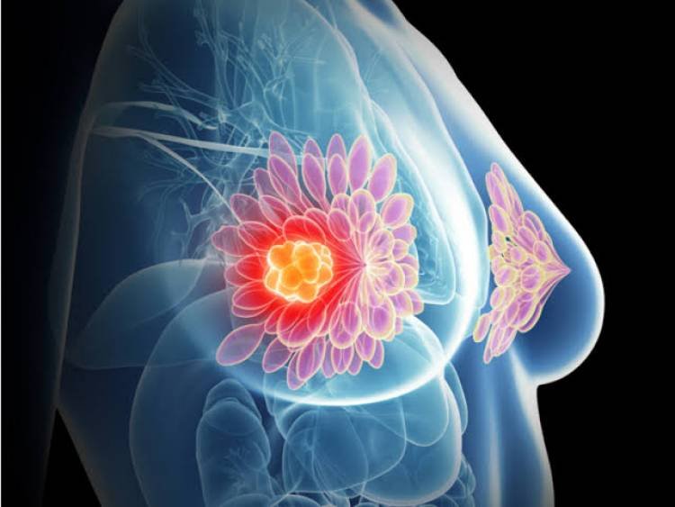 First China made biosimilar for breast cancer to be out soon